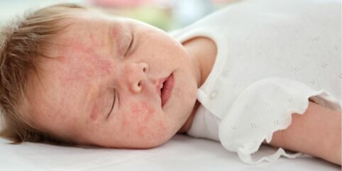 atopowe zapalenie skóry u niemowlęcia